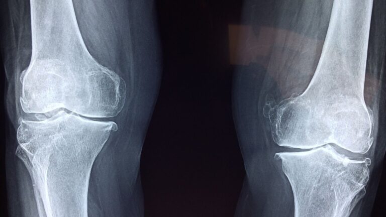 Doctor explains weather-related joint pain